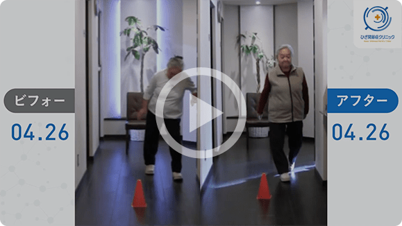 患者様の治療前後の歩行比較動画１