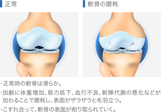 膝関節症の軟骨