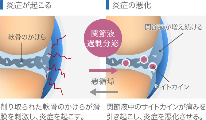 膝の痛みの原因