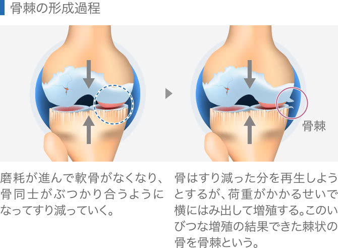 骨棘の形成過程