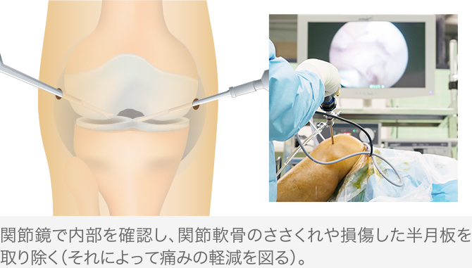 関節内視鏡下手術