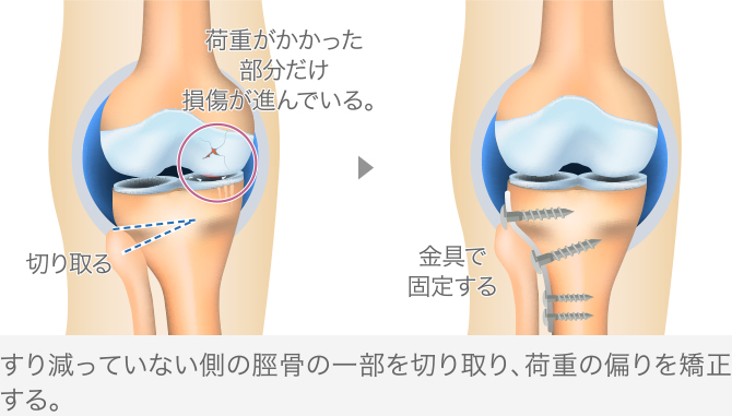 高位脛骨骨切り術