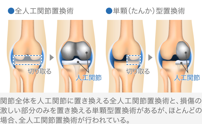 人工関節置換術