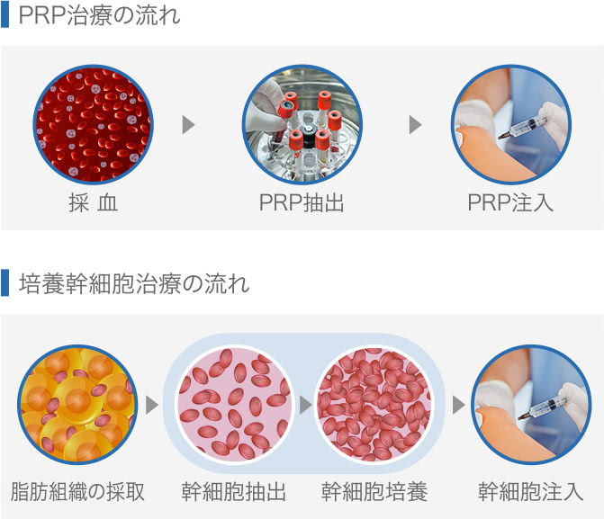 PRP治療と培養幹細胞治療の流れ