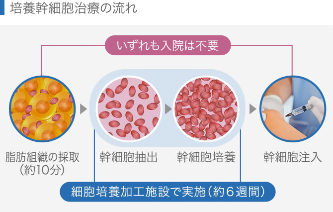 培養幹細胞治療の流れ