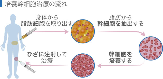 培養幹細胞治療の流れ