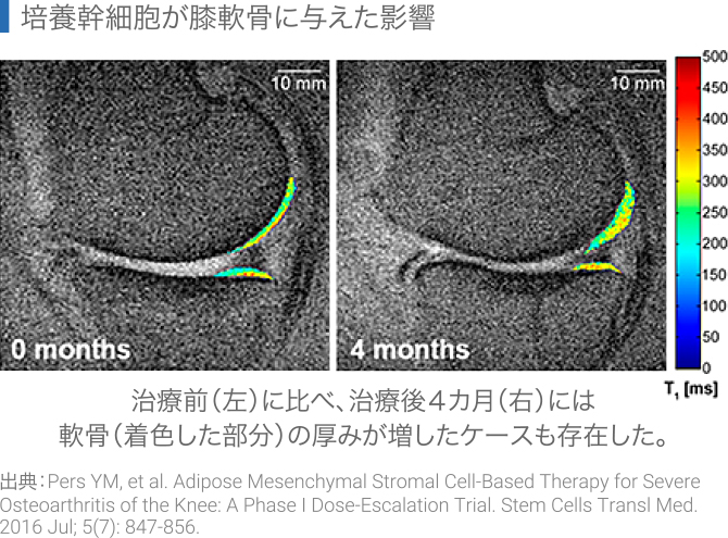 培養幹細胞が膝軟骨に与えた影響