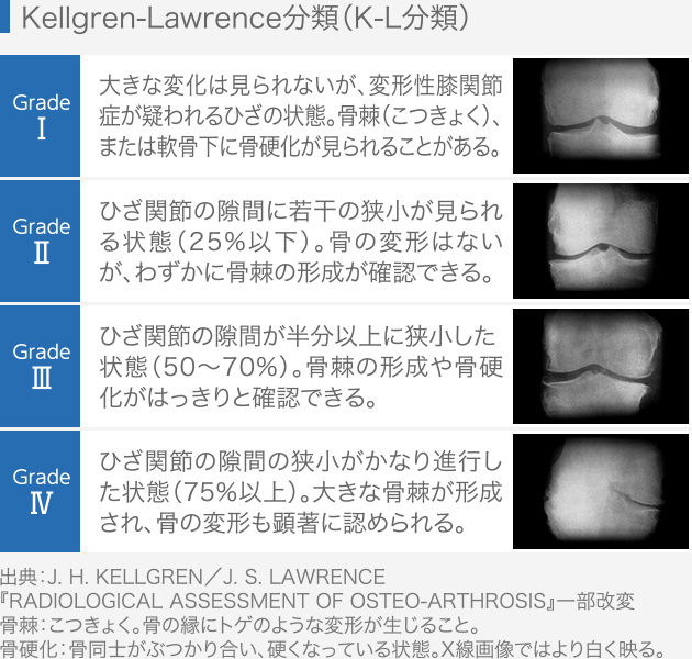 変形性膝関節症のグレード