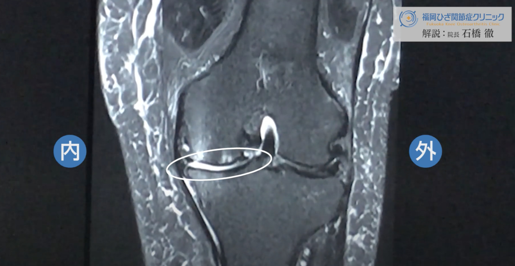 【膝MRI】70代前半｜変形性膝関節症の症例を解説します